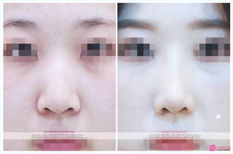 긴코성형 이곳에서 여성스러워진 여자코수술후기 사진 7