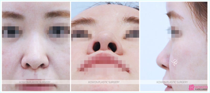 코끝내리기 양악후코수술 실리콘 없이 진행한 사례 사진 3