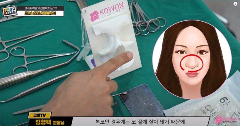 비염코성형 자신에게 잘 맞는 코성형재료 알아보기 사진 10