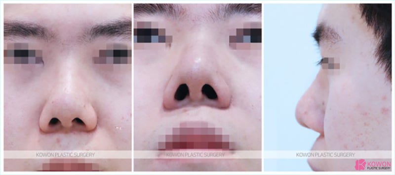 남성코성형 복코도 자연스럽게 해결하는 신사역코성형외과
