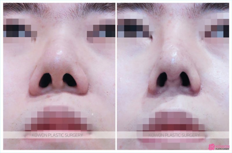 남성코성형 복코도 자연스럽게 해결하는 신사역코성형외과 사진 7