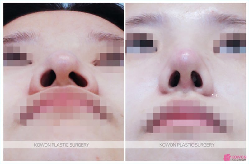 휜코수술후기 만족스러운 효과를 서울코재수술 잘하는곳에서 사진 7