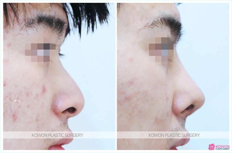 비중격만곡증수술 세련된 이미지 만든 남자코수술후기 사진 8
