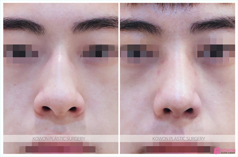 무보형물코수술 잘하는곳에서 진행한 압구정코수술 사진 8