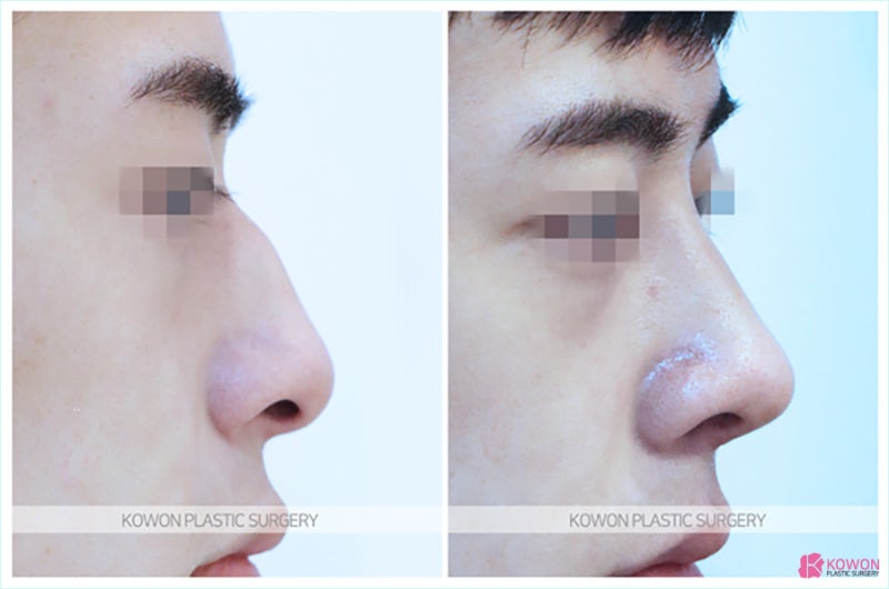 무보형물코수술 잘하는곳에서 진행한 압구정코수술 사진 4
