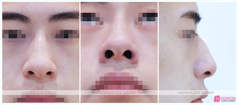 무보형물코수술 잘하는곳에서 진행한 압구정코수술
