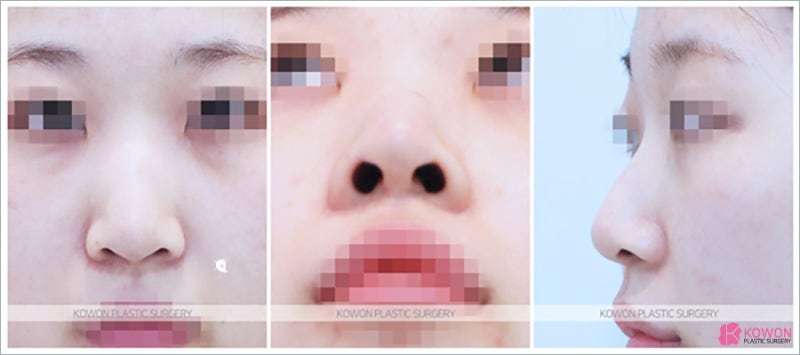 강남코성형잘하는곳 만족스러운 켈로이드성형 후기