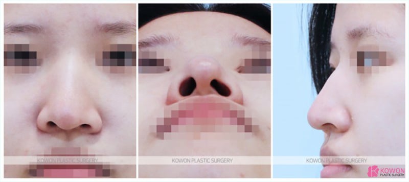 여자매부리코 문제 해결하는 코성형수술잘하는곳 사진 3