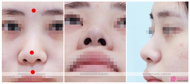 코끝비중격 개별적 맞춤진행한 여자복코수술 사진 2