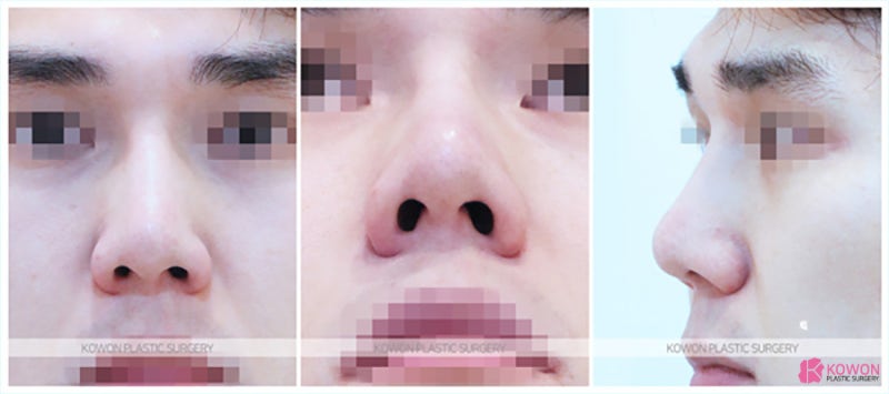 남자코성형전후 화려한 이미지로 변화시킨 신사코성형외과 사진 2