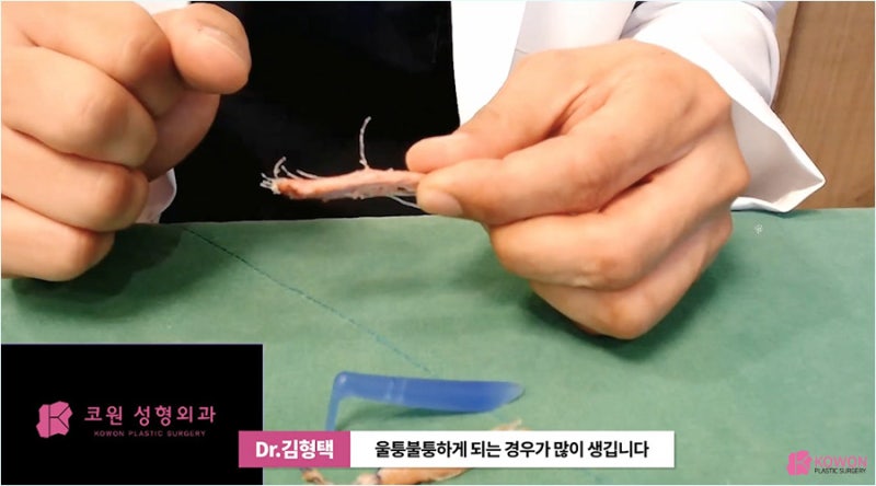 자가진피코수술 노하우로 진행한 코끝실제거 사진 14