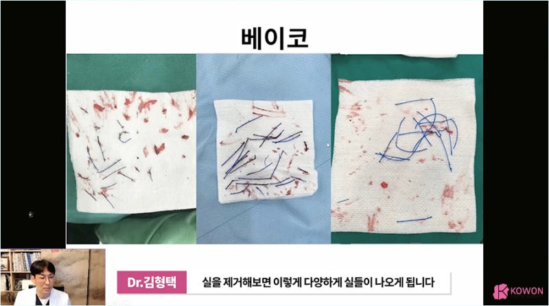 자가진피코수술 노하우로 진행한 코끝실제거 사진 6