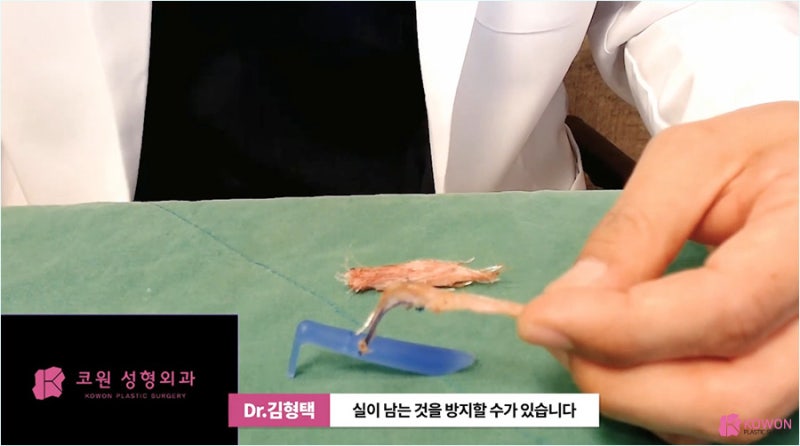 자가진피코수술 노하우로 진행한 코끝실제거 사진 11