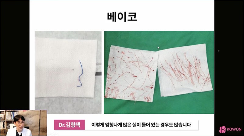 자가진피코수술 노하우로 진행한 코끝실제거 사진 7
