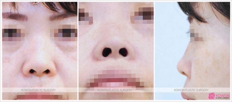 코성형유명한곳 에서 받는 맞춤 비개방코성형 사진 2