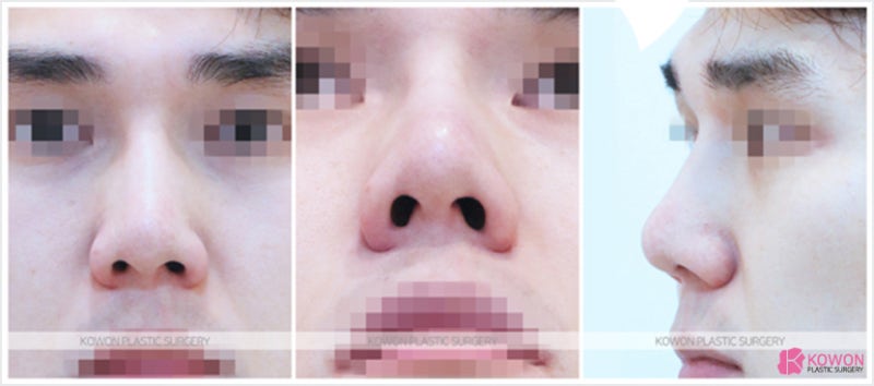 코끝수술가격 얼굴과 조화롭게 짧은코성형 사진 2