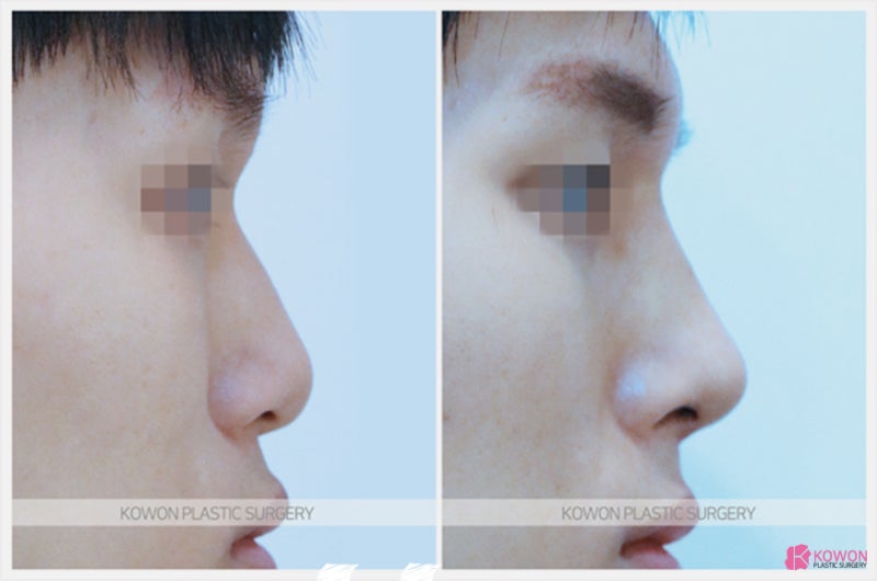 코수술잘하는곳 매부리코수술 논현동성형외과 사진 8