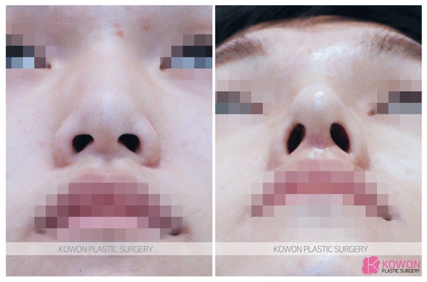 직반버선코 자연스럽게 하는 코수술유명한곳 사진 5