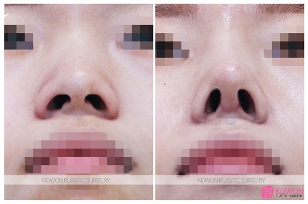 주먹코성형 수술사례 콧볼줄이는법 사진 7