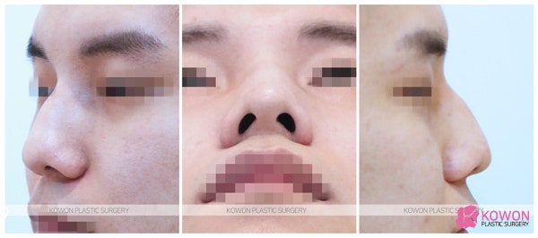 비염코성형 해결하는 신사동코성형