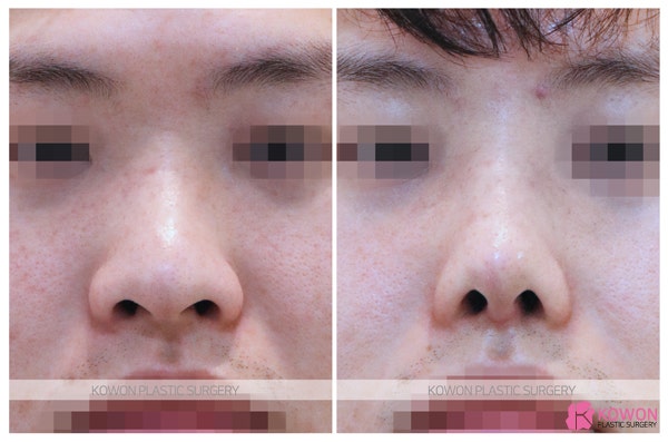 콧볼작아지는법 해결방법은 비절개코성형 사진 6