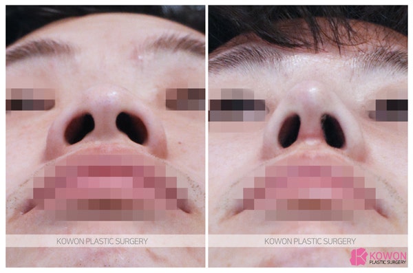 콧볼작아지는법 해결방법은 비절개코성형 사진 3