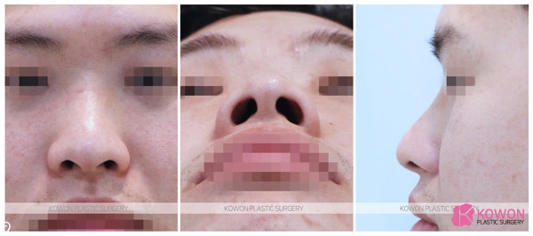콧볼작아지는법 해결방법은 비절개코성형