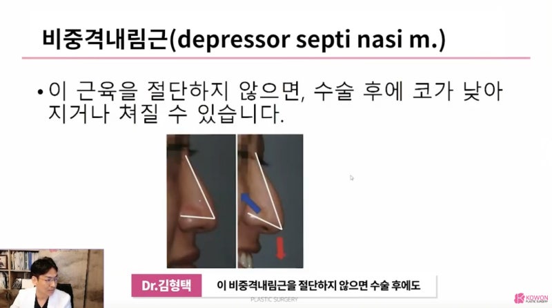 화살코 수술 시 절단해야 하는 상순비익올림근 사진 4