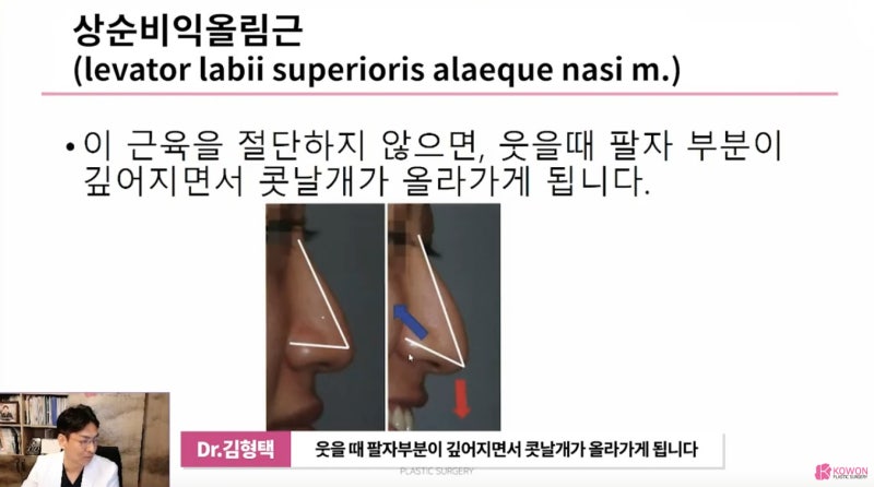 화살코 수술 시 절단해야 하는 상순비익올림근 사진 5