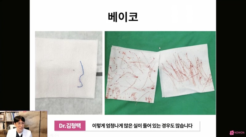 논현역성형외과 베이코 설명 50대코수술 사진 7