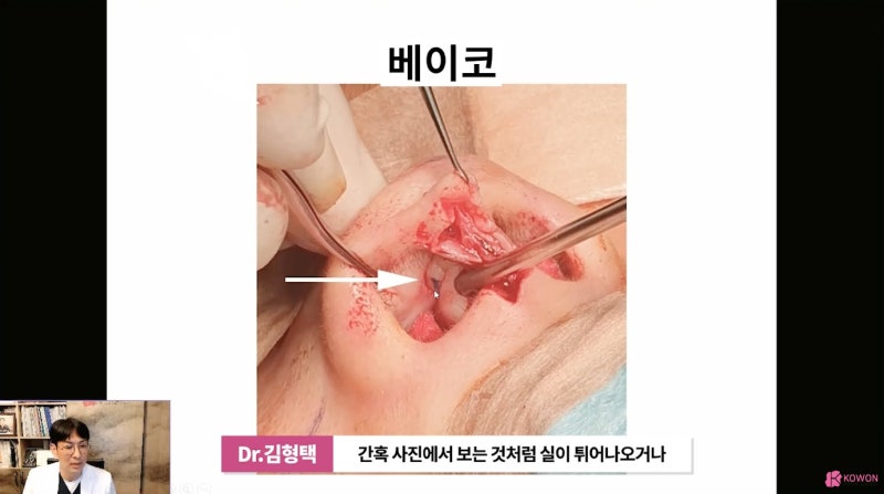 논현역성형외과 베이코 설명 50대코수술 사진 5