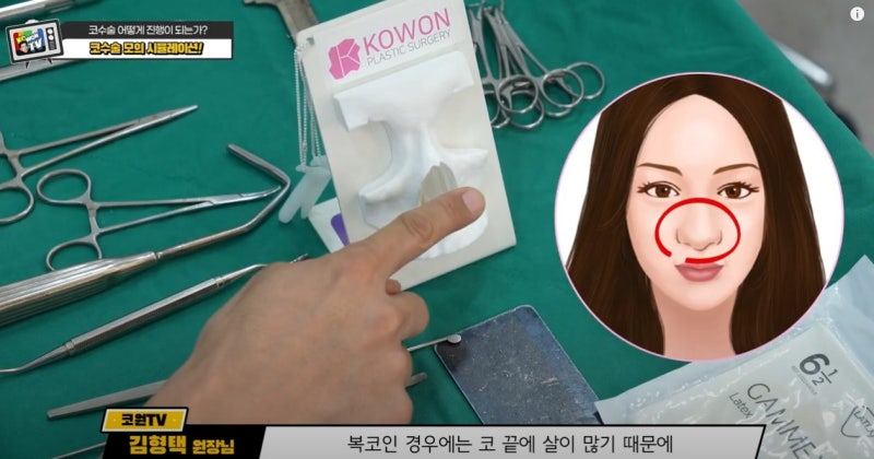 신사역코성형외과의 코성형과정 수술전 필독 사진 10