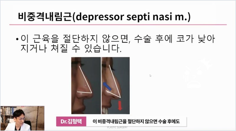 강남코성형 코수술후낮아짐 긴코 증상 원인 사진 11