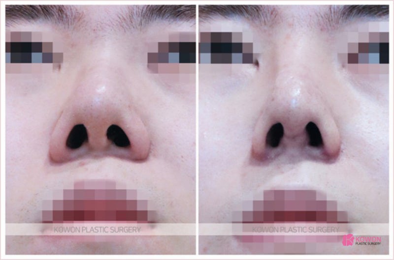 압구정코재수술 잘하는 코원의 치료 사례 (콧날개올리기) 사진 7