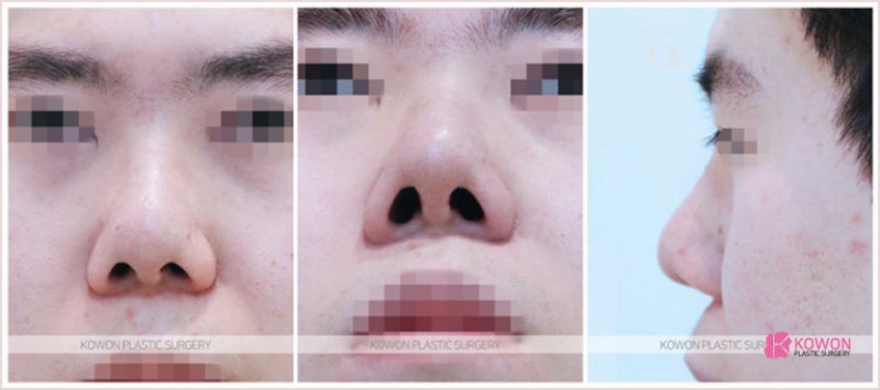 압구정코재수술 잘하는 코원의 치료 사례 (콧날개올리기) 사진 2