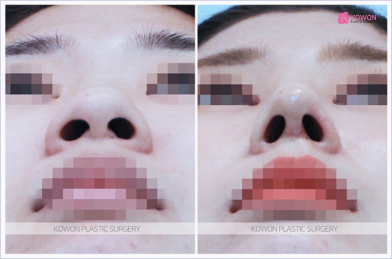 신사성형외과 들창코수술 전후 성공 사례 사진 6