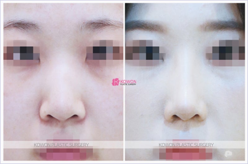 압구정코수술 자연스러운 코끝올리기 전후 성형 후기 사진 7