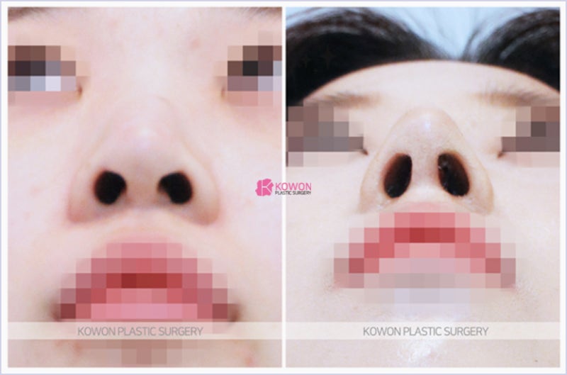 압구정코수술 자연스러운 코끝올리기 전후 성형 후기 사진 6