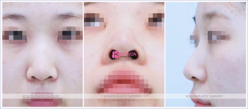 압구정코수술 자연스러운 코끝올리기 전후 성형 후기 사진 2