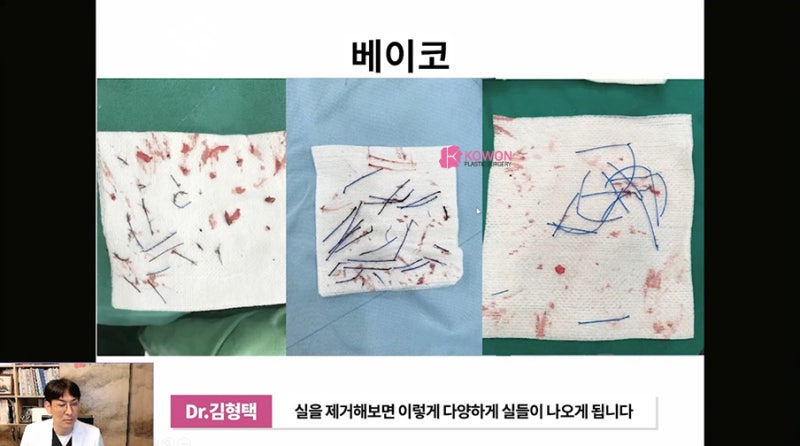 가로수성형외과 코수술후실 제거 방법 시술 사진 6