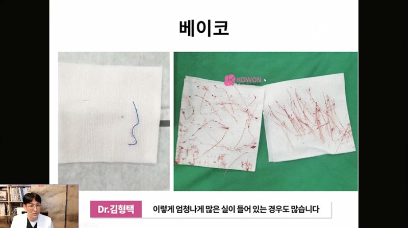 가로수성형외과 코수술후실 제거 방법 시술 사진 7