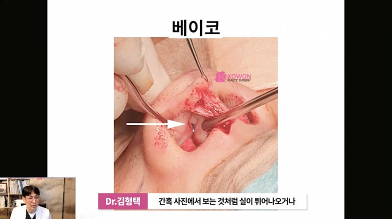 가로수성형외과 코수술후실 제거 방법 시술 사진 5