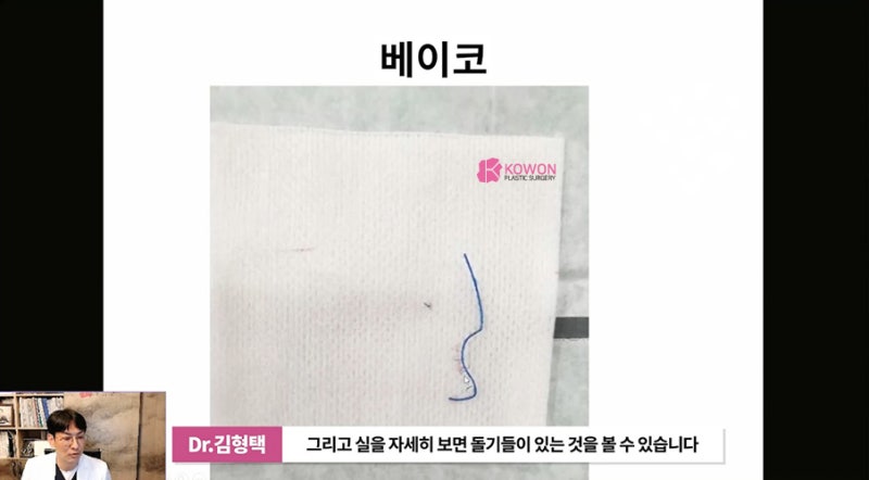 가로수성형외과 코수술후실 제거 방법 시술 사진 9