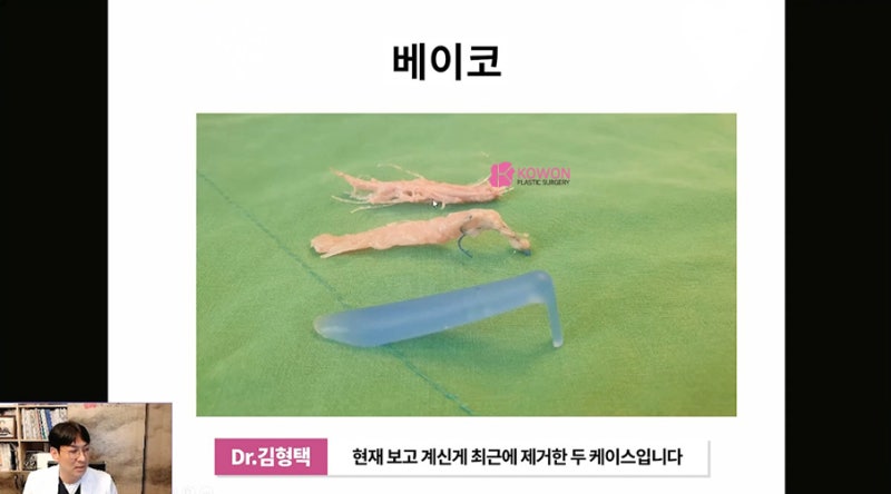 가로수성형외과 코수술후실 제거 방법 시술 사진 10