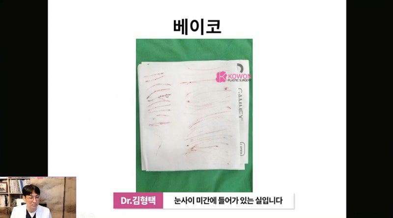 가로수성형외과 코수술후실 제거 방법 시술 사진 8