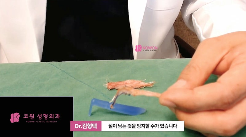 가로수성형외과 코수술후실 제거 방법 시술 사진 11