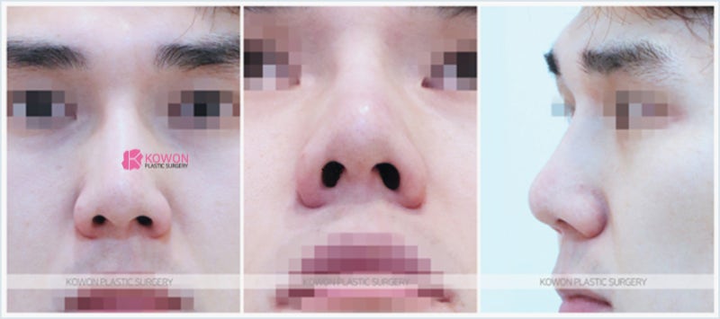 강남코수술 콧대높이는 방법 어떻게 성형할까 사진 2