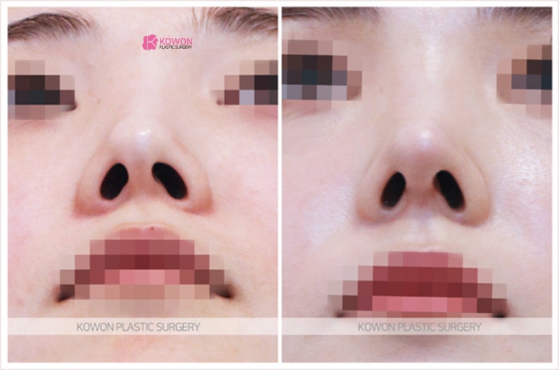 신사역성형외과 비중격만곡증 수술 후기 사진 6