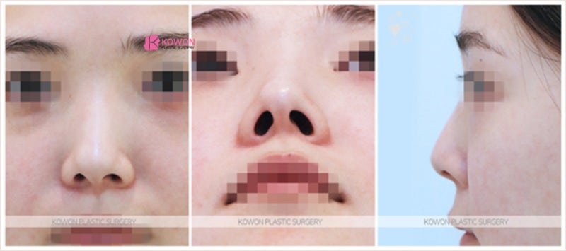 신사역성형외과 비중격만곡증 수술 후기 사진 2