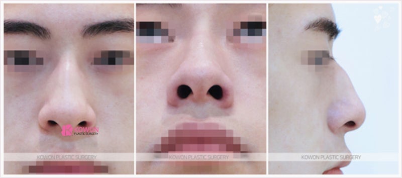 청담코성형 남자매부리코 매끈하게 만든 수술 전후 사례 사진 2